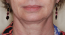 Ultherapy