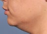 Ultherapy