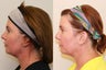 Ultherapy