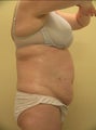 Ultrashape