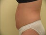Ultrashape