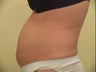 Ultrashape