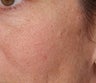 V Beam treatment for Rosacea
