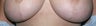 Laser treatment for breast implant scars