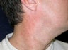 VBeam treatment for neck redness