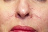 Vein treatment