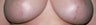 Laser treatment for breast implant scars