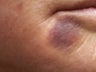 V Beam treatment of a bruise