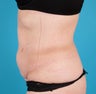 VASER Shape to Abdomen