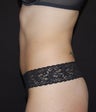 VASER Shape to Abdomen