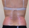 VASER Shape fo Back