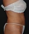 VASER Shape to Abdomen