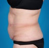VASER Shape to Abdomen