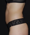 VASER Shape to Abdomen
