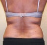VASER Shape fo Back