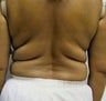 VASER Shape to Back
