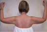 Arm Lift