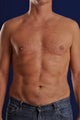 Vaser Hi Def Liposuction