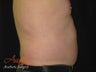 Vaser Lipo - Abdomen