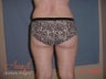 Vaser Lipo - Outer Thighs