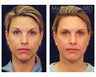 Liposuction