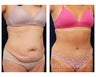 Tummy Tuck with Liposuction