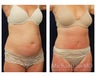 Tummy Tuck with Liposuction