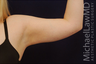 Liposuction