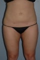 Liposuction