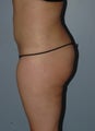 Liposuction