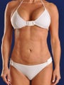 Vaser Hi Def Liposuction of chest, abdomen, back and flanks