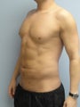 VASER Liposuction (HiDef)