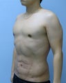 VASER Liposuction (HiDef)