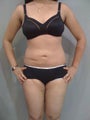 VASER Lipo - 25 yrs. old female (abdomen, back, flanks & thighs)