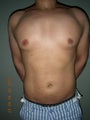 Vaser Liposuction
