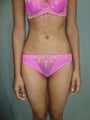 Vaser Liposuction