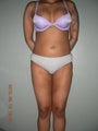 VASER lipo with Brest augmentation