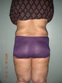 VASER lipo - Butt reduction