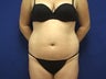 VASER Liposelection