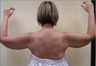 Arm Lift