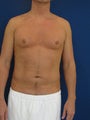 Vaser Hi Def Liposuction