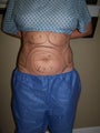 Vaser liposuction