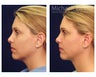 Liposuction