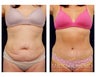 Tummy Tuck with Liposuction