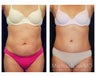Tummy Tuck with Liposuction