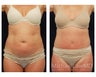 Tummy Tuck with Liposuction