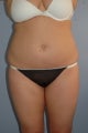 Liposuction