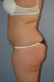 Liposuction