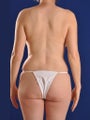 Vaser Hi Def Liposuction of abdomen, thighs, flanks and back with fat injections to buttocks