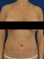 Vaser Hi Def Liposuction of chest, abdomen, back and flanks